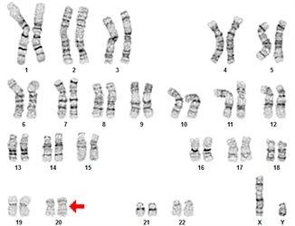 G-Banded karyogram showing dup 20 abnormality